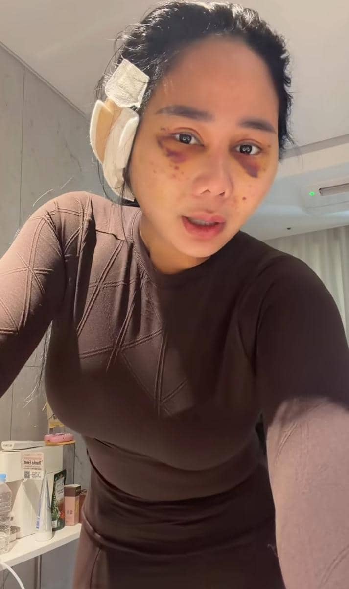 potret Denise Chariesta operasi plastik