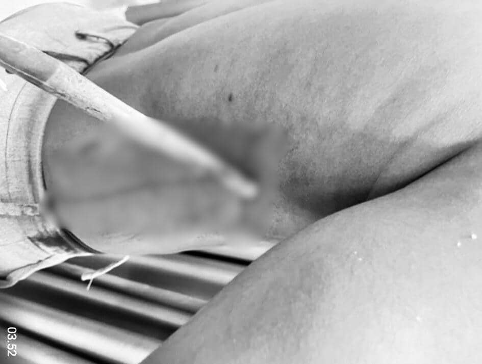 Anak panah menancap di bagian rusuk kanan tubuh korban. (IDN Times/Dok. Humas Polres Mimika)