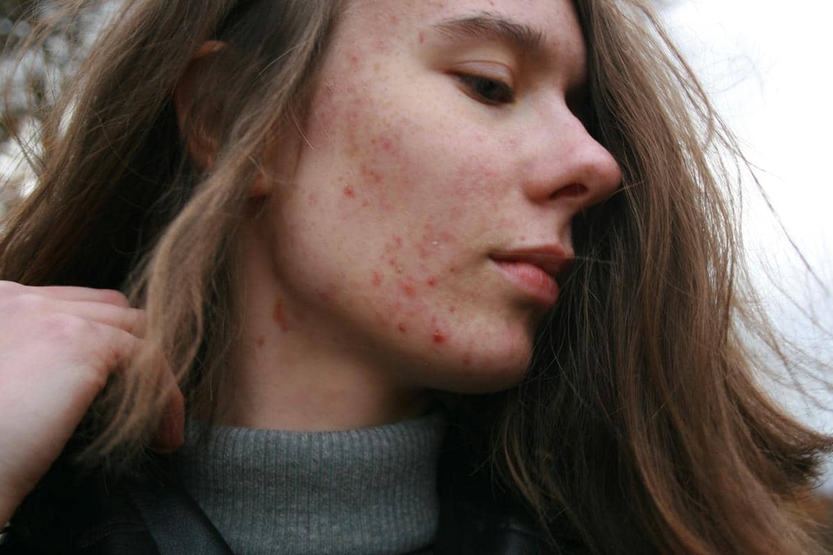 Perbedaan Acne dan Pimple, Perawatannya Tidak Sama