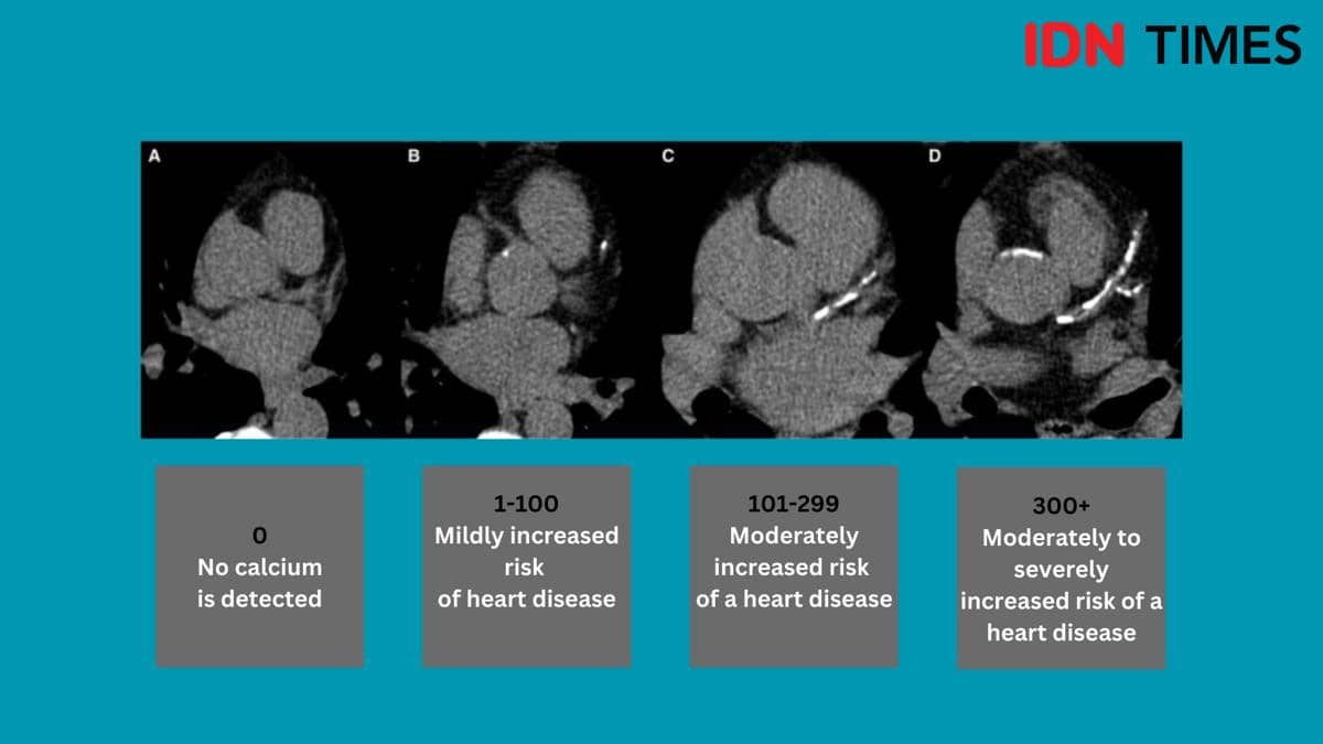 Hasil calcium score.
