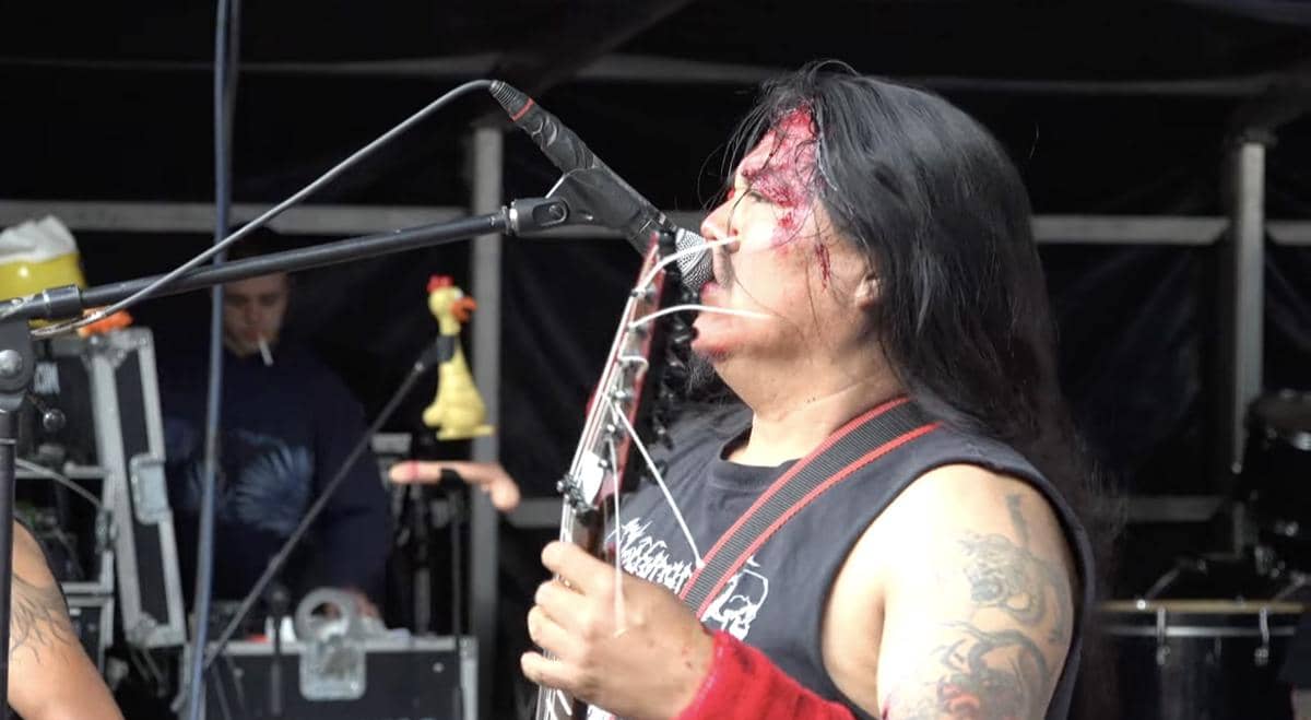 Paracoccidioidomicosisproctitissarcomucosis