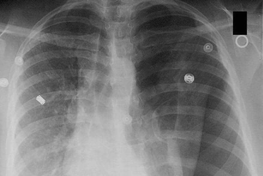 ilustrasi pneumotoraks 