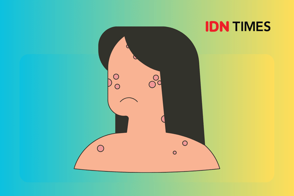 Ilustrasi cacar atau smallpox.