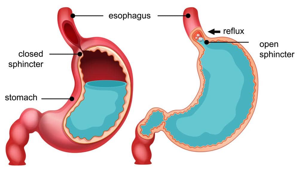 Kondisi lambung penderita GERD