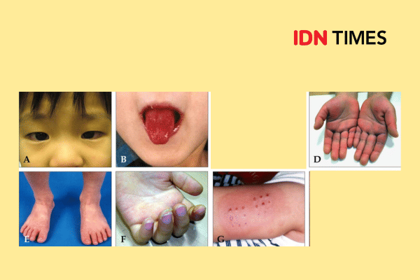 Gejala penyakit Kawasaki.