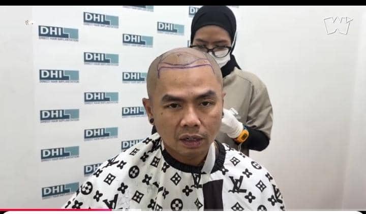 potret Wendi Cagur transplantasi rambut
