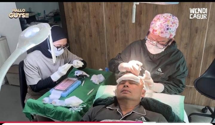 potret Wendi Cagur transplantasi rambut