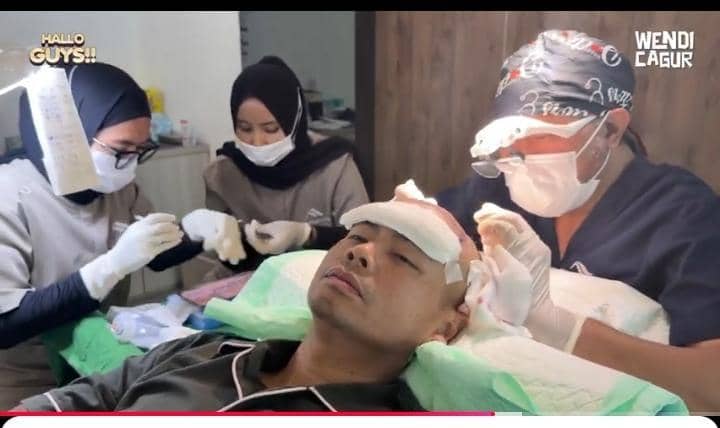 potret Wendi Cagur transplantasi rambut