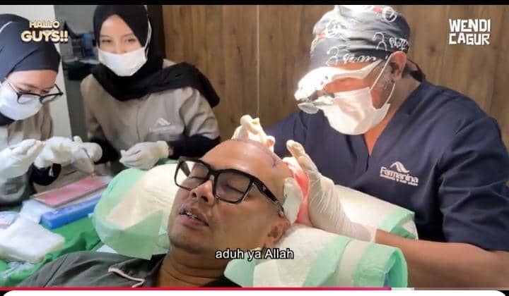 potret Wendi Cagur transplantasi rambut