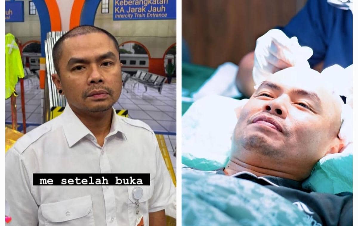 9 Potret Wendi Cagur Transplantasi Rambut, untuk Kesehatan