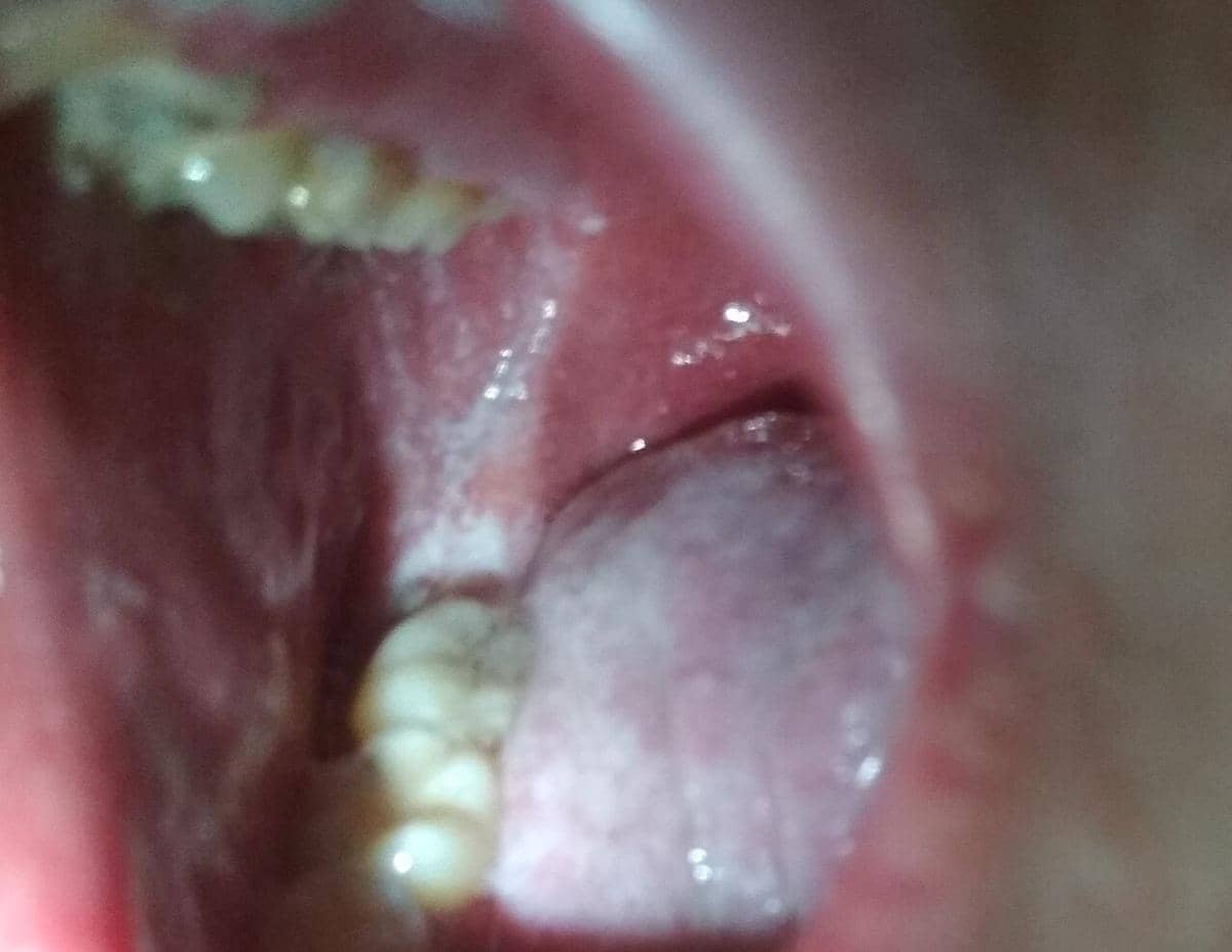 Koplik spot, tanda khas campak di dalam mulut.