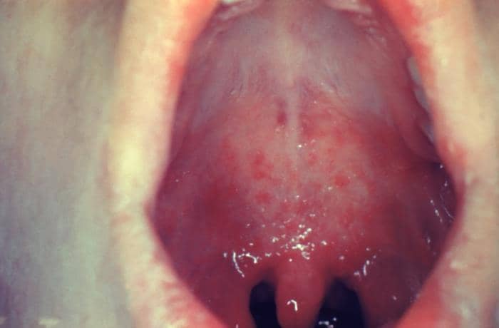 Seperti Apa Bintik Koplik? Tanda Campak yang Khas