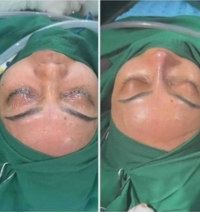 Rina Nose Operasi Hidung (instagram.com/rinanose16)