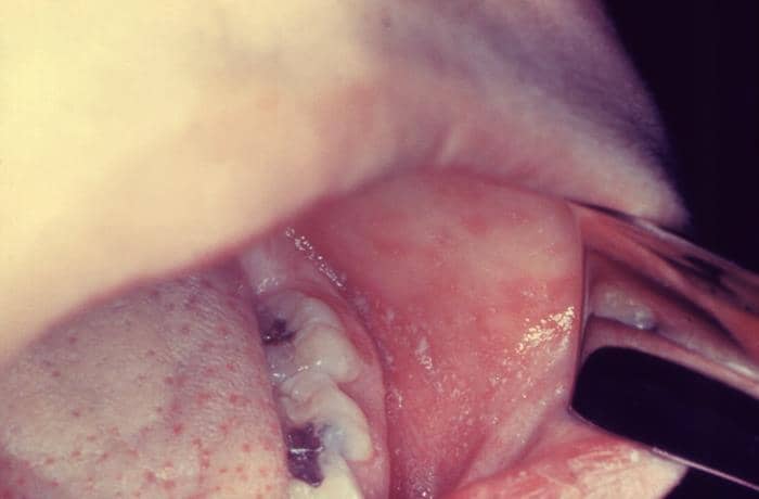 Bintik Koplik (Koplik's spots), tanda khas campak di dalam mulut. 