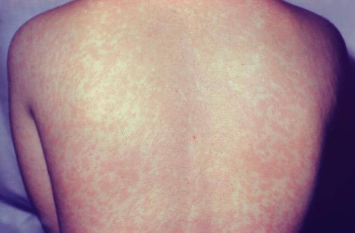 Ruam campak di punggung pada hari kelima penyakit.