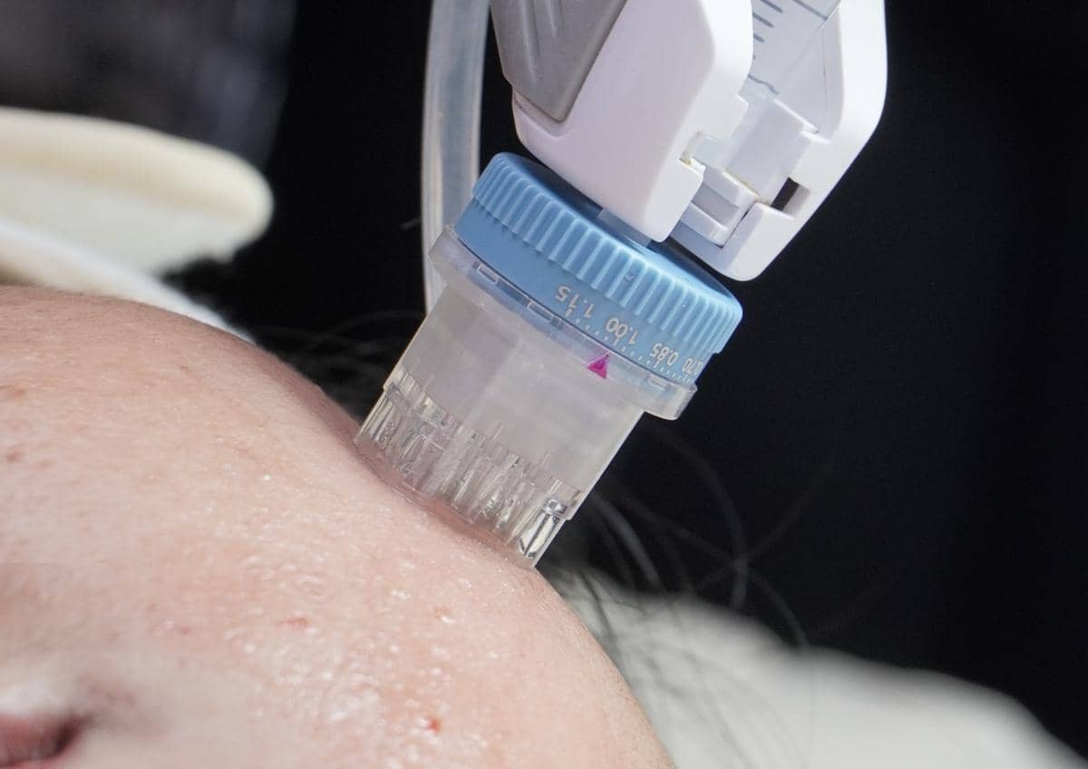 Teknologi Injector Skinbooster Bikin Kulit Wajah Awet Muda dan Glowing