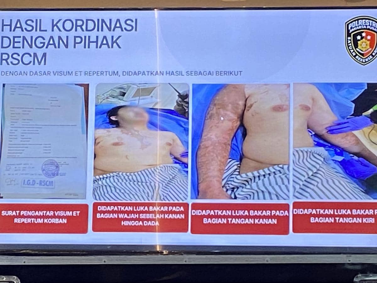 Kondisi Andrie Yunus usai disiram air keras oleh OTK (IDN Times/Irfan Fathurohman)