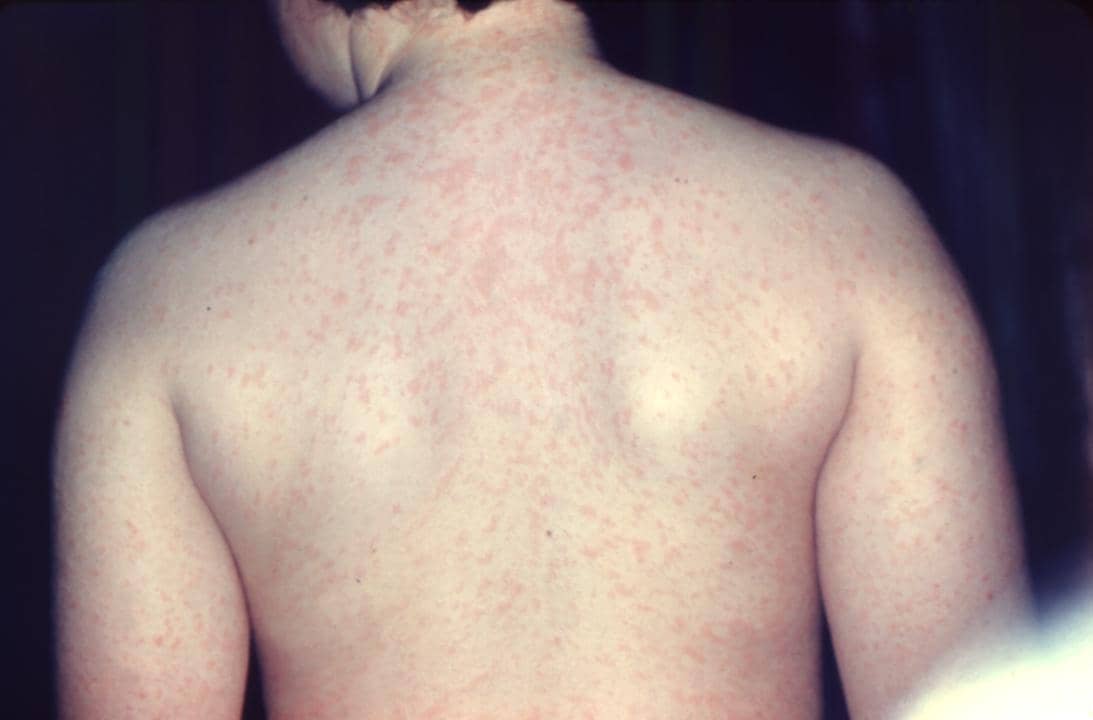 Apa Perbedaan Campak pada Anak-anak dan Orang Dewasa?