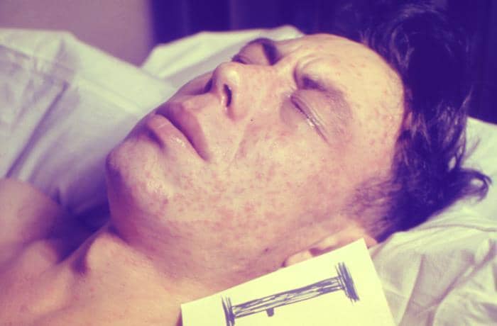 Seorang pasien dewasa terbaring sakit akibat campak.