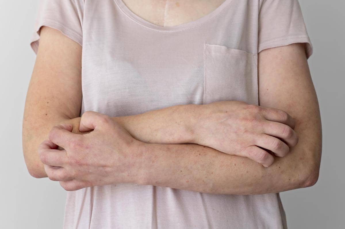 Ilustrasi gatal-gatal pada lengan