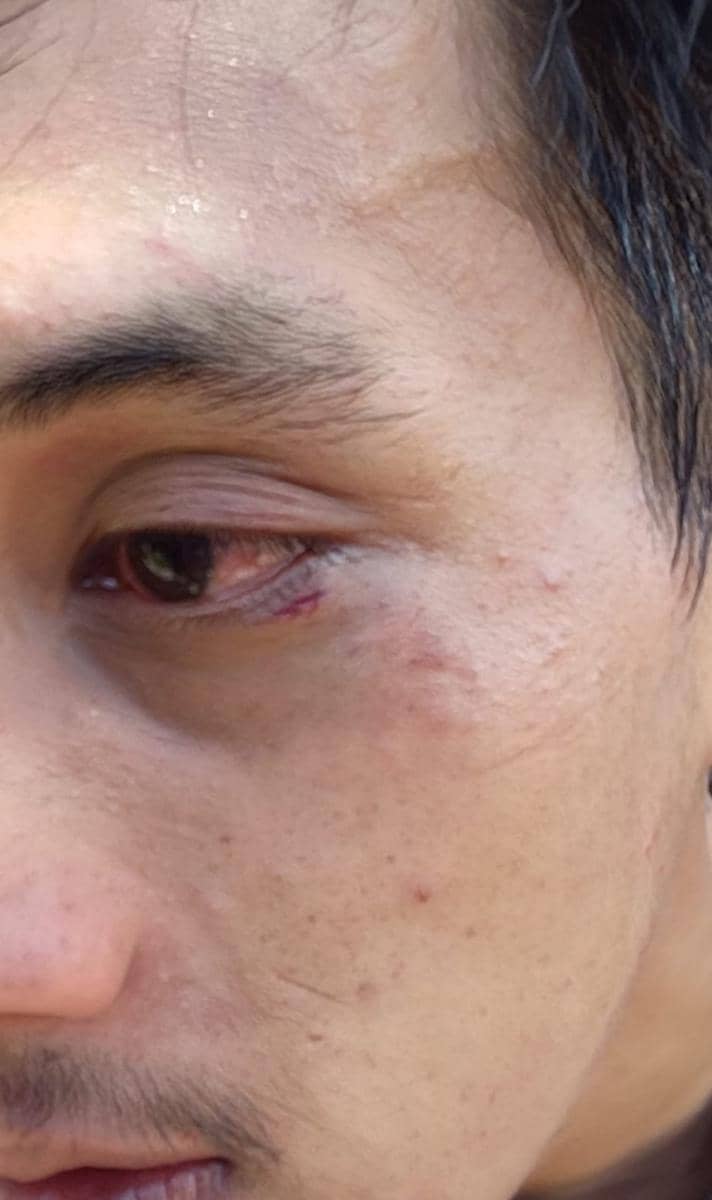 Anggota Gerakan Aktivis Mahasiswa (GAM) Makassar menderita luka lebam pada bagian mata akibat pukulan dari orang tak dikenal saat demonstrasi solidaritas untuk Andrie Yunus, Kamis (9/4/2026). Dok. GAM Makassar