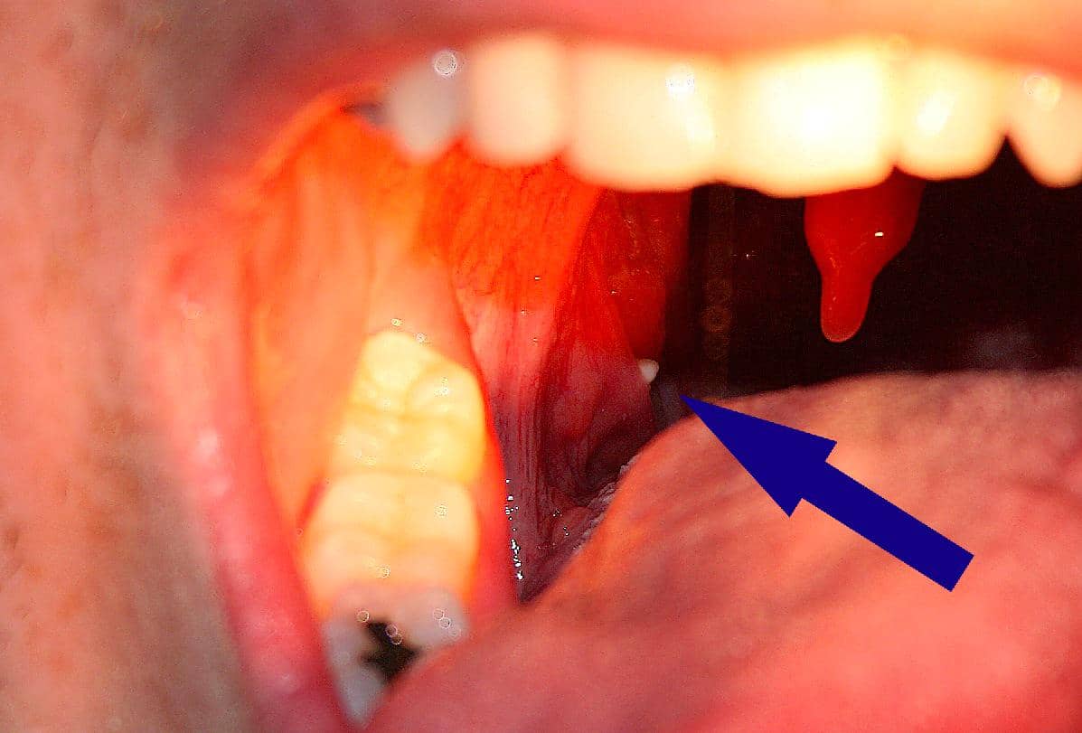 Bagian dalam mulut seseorang dengan panah biru menunjuk ke batu amandel berwarna putih di area tonsil.