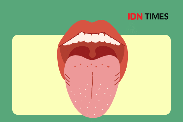 Apa Itu Amandel Berlubang? Ini Penjelasannya