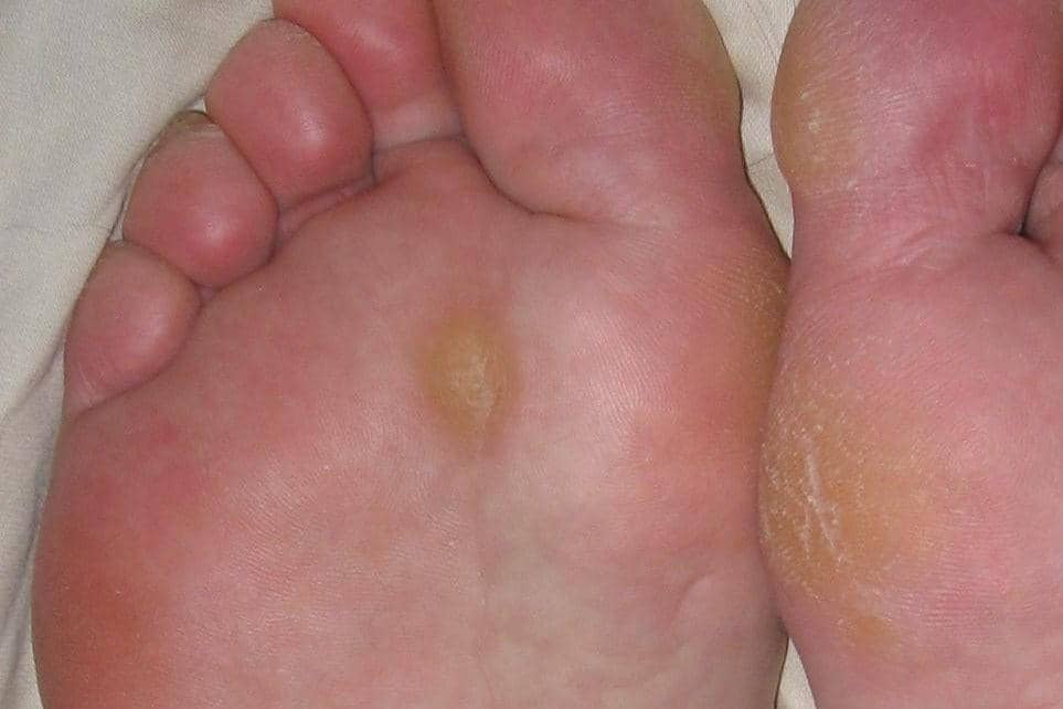 Telapak kaki dengan area kulit menebal berwarna kekuningan di bagian tengah sebagai ilustrasi kapalan pada kaki.