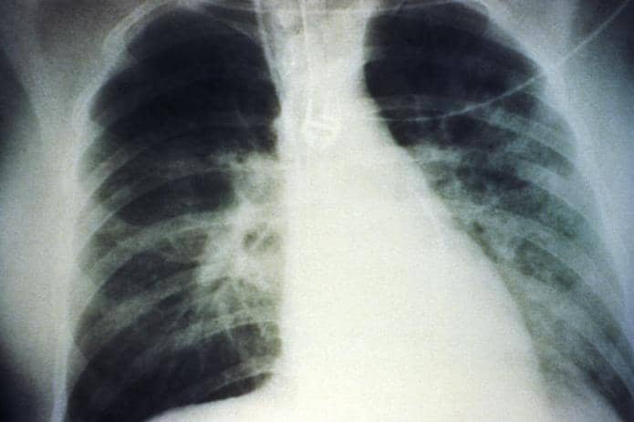 foto rontgen dada akibat sindrom paru hantavirus atau HPS