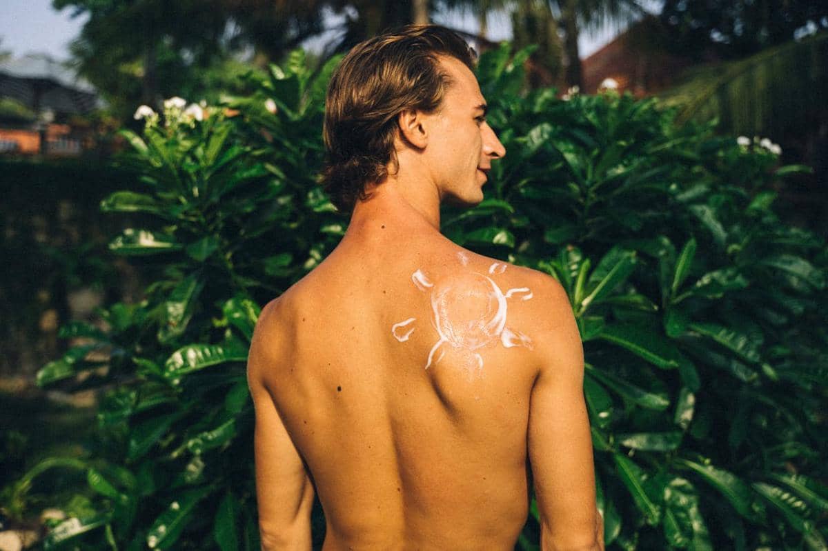 Sunburn