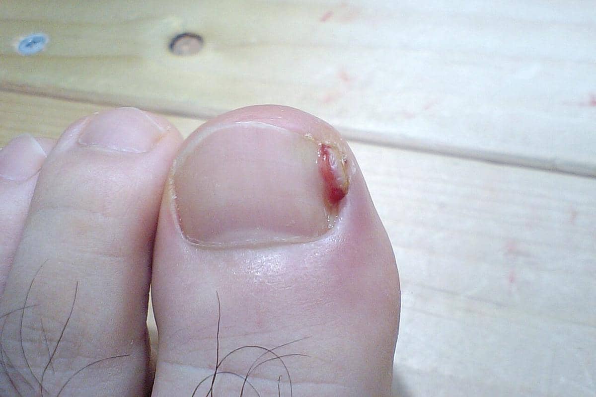 Kuku jempol kaki mengalami cantengan dengan area kulit di tepi kuku tampak merah dan sedikit bengkak akibat peradangan.