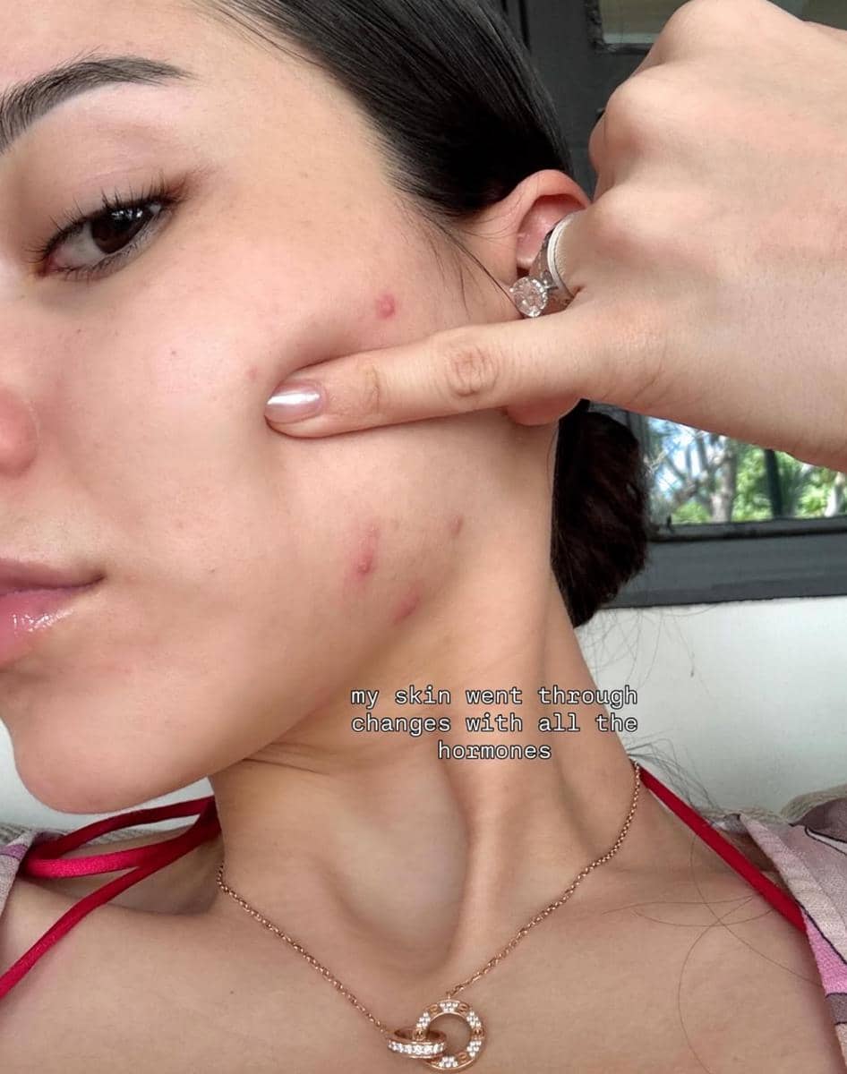 Seorang wanita memperlihatkan kondisi kulit wajahnya dengan beberapa jerawat di pipi, mengenakan kalung dan cincin berlian.