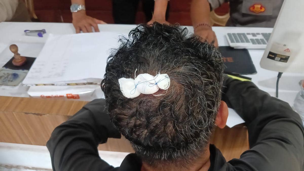 Pria di Badung Diserang Saat Berangkat Kerja, Dapat 6 Jahitan di Kepala
