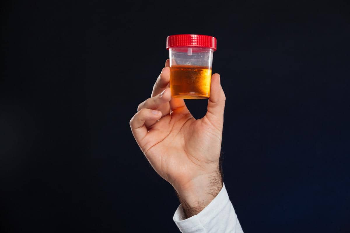 ilustrasi warna urine yang lebih gelap