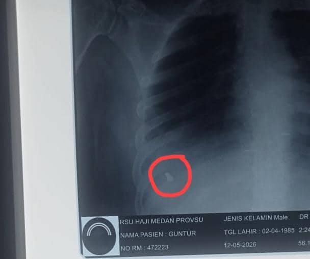 Satpam Dapur MBG Ditembak Begal, Terkendala Biaya Operasi