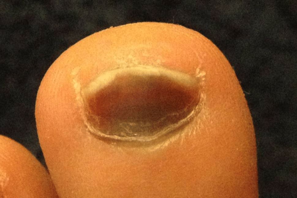 Kuku jari kaki dengan hematoma subungual berwarna gelap di bawah kuku akibat tekanan atau cedera, dikenal sebagai runner's toe.