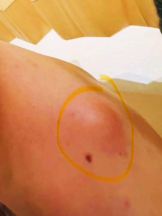 Bagian bahu seseorang tampak mengalami benjolan berwarna kemerahan yang dilingkari dengan garis kuning.