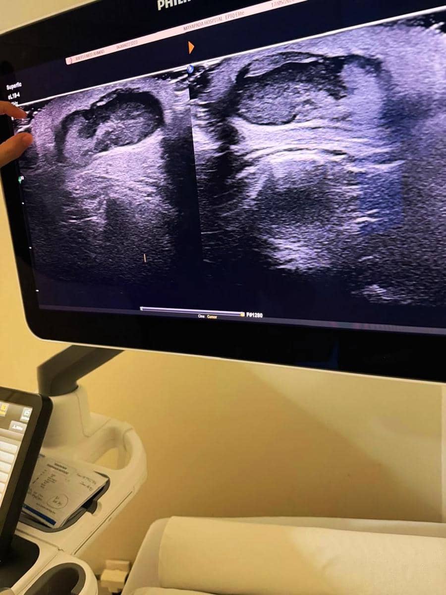 Layar monitor menampilkan hasil pemeriksaan ultrasonografi medis dengan dua gambar hitam putih di ruang rumah sakit.