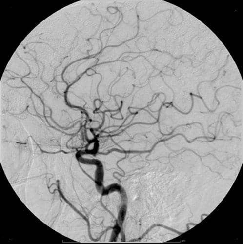 Angiogram serebral menunjukkan pembuluh darah otak dengan media kontras berbasis yodium untuk visualisasi aliran darah.