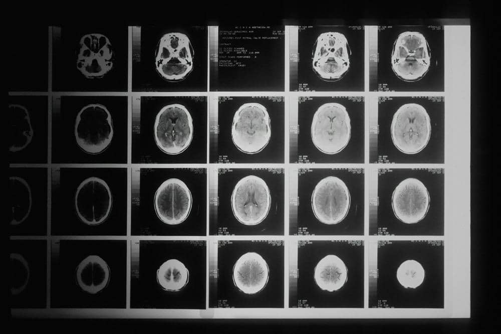 ilustrasi hasil foto MRI