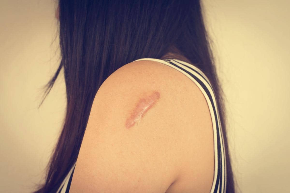 ilustrasi keloid