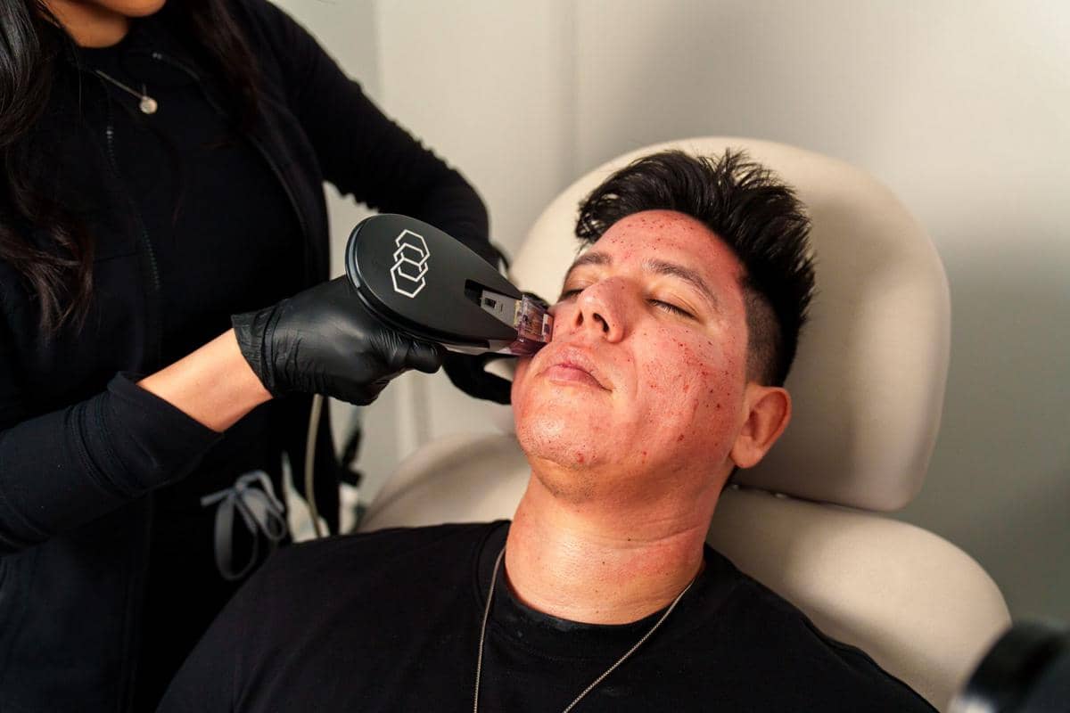 ilustrasi proses microneedling