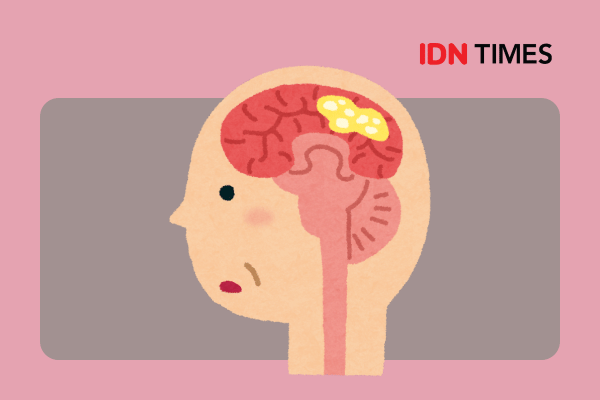 Apa Saja Jenis Tumor Otak yang Paling Umum?
