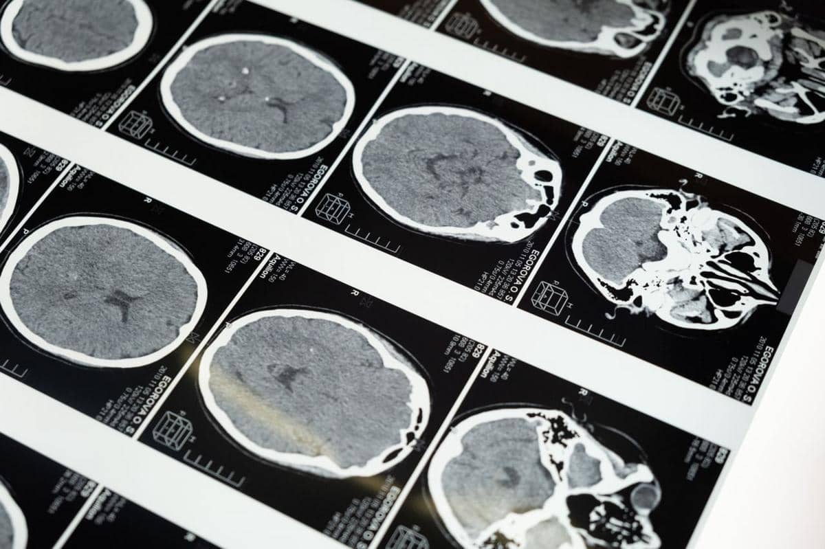 Tumor Otak Primer dan Sekunder, Apa Bedanya?