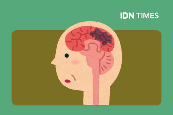 Apakah Tumor Otak Bisa Diturunkan dalam Keluarga?