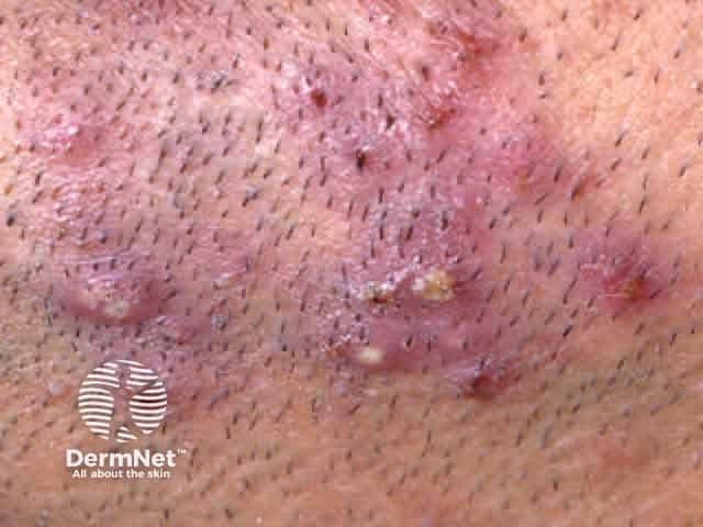 Kulit wajah dengan folikulitis barbae menampilkan benjolan merah meradang di area pertumbuhan rambut akibat infeksi folikel rambut.