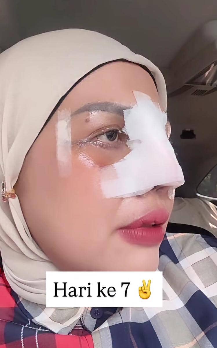Seorang perempuan berhijab dengan perban putih di hidung dan pipi, tampak di dalam mobil pada hari ketujuh setelah operasi.