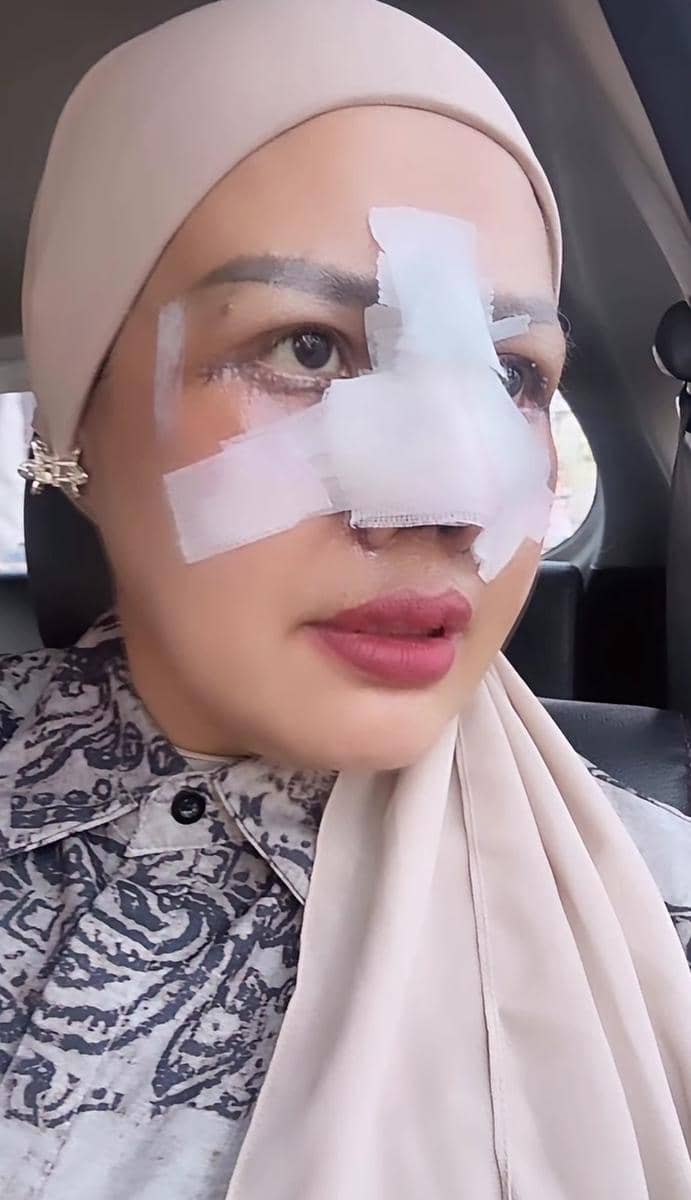 Seorang perempuan berhijab duduk di dalam mobil dengan perban menutupi hidung dan area wajah setelah menjalani operasi plastik.