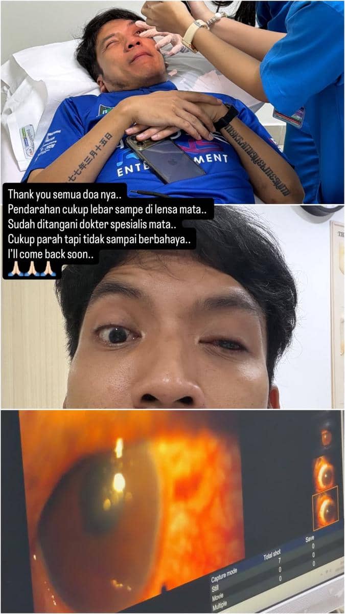 Seorang pria menjalani perawatan mata di rumah sakit setelah mengalami cedera akibat bola padel, dengan tampilan mata bengkak dan hasil pemeriksaan medis.
