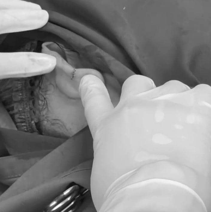 Tangan dokter mengenakan sarung tangan sedang melakukan operasi pada bagian telinga pasien dengan area sekitar tertutup kain medis.